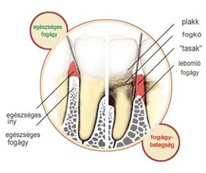 fórum dental fogászat ügyelet debrecen fogágy betegségek
