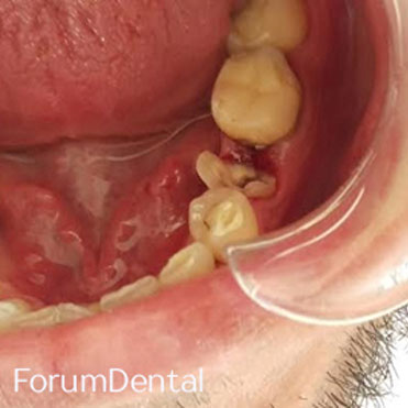 fórum dental fogászat ügyelet debrecen onlay preparalas