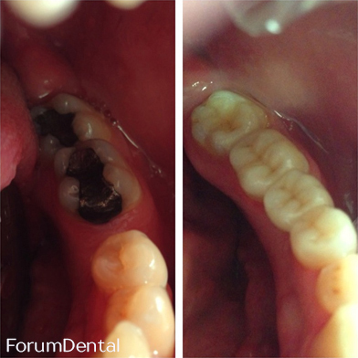fórum dental fogászat ügyelet debrecen rétegzős kerámia