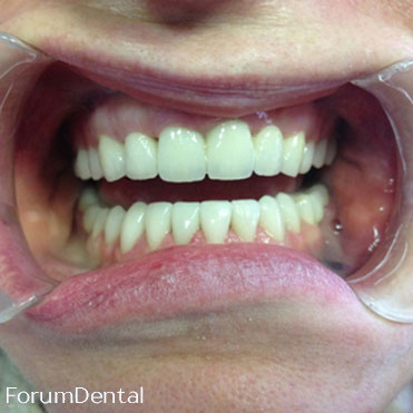fórum dental fogászat ügyelet debrecen teljes protetikai rehabilitálás 2