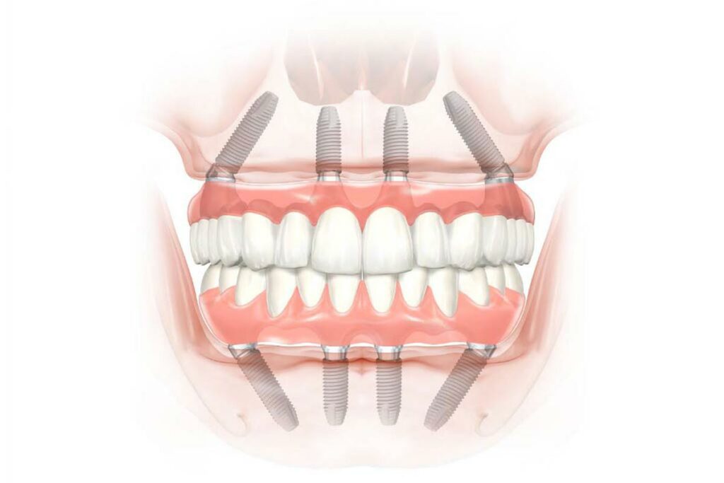fórum dental fogászat ügyelet debrecen all on four