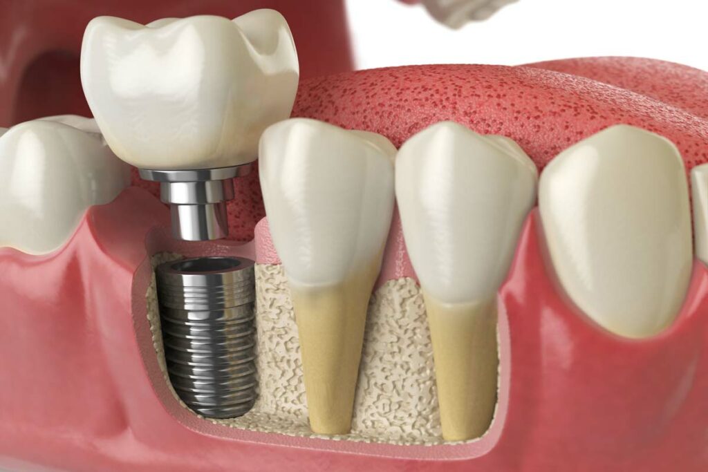 fórum dental fogászat ügyelet debrecen fogorvosi implantátum