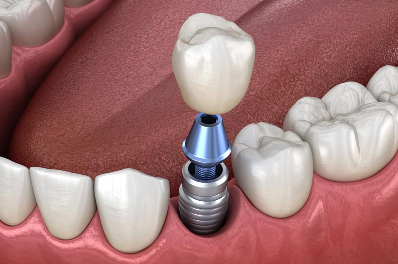 fórum dental fogászat ügyelet debrecen fogpótlás
