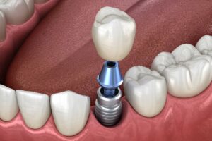 fórum dental fogászat ügyelet debrecen fogpótlások