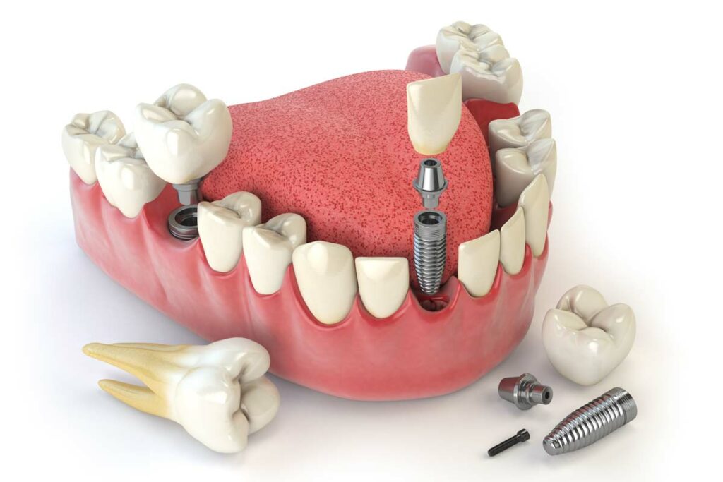 fórum dental fogászat ügyelet debrecen fontos elveszett fogakat pótolni