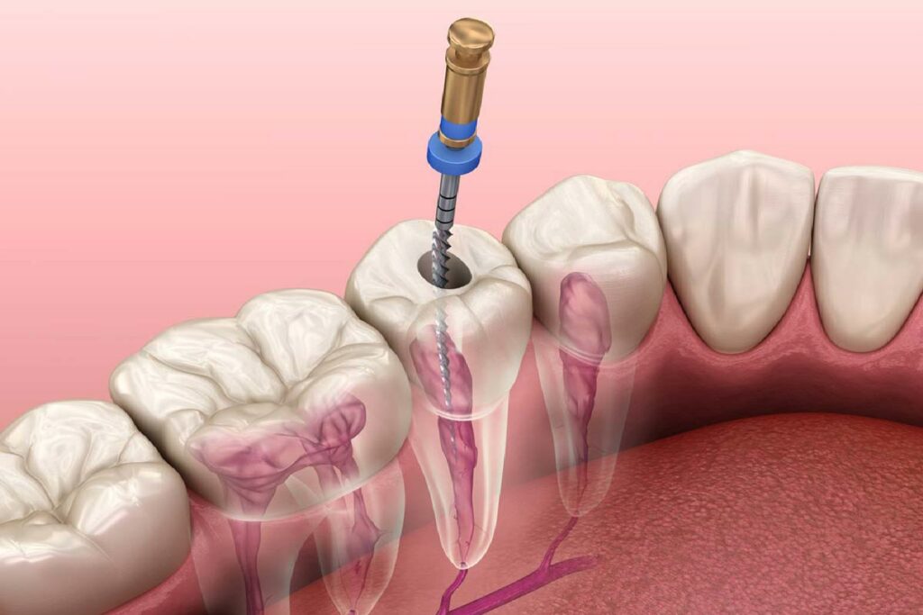 fórum dental fogászat ügyelet debrecen gyökérkezelés