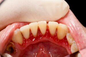 fórum dental fogászat ügyelet debrecen ínygyulladás veszélye