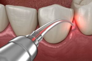 fórum dental fogászat ügyelet debrecen lézerterápia